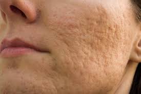 Pico Laser Treatment for Acne Scars